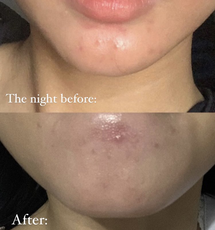 i'm wearing this moisturizer dari dorskin yang sempet viral! even sampe sekarang aku selalu pake ini buat sleeping mask dan obat totol jerawatku! 

matcha glow dream mask dorskin beneran se-AJAIB itu buat atasin jerawat, dalam semalam jerawat langsung mateng dan better! 🤩🤍