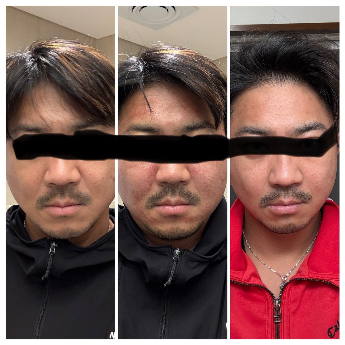 YOU&amp;Iクリニック江南

１．無痛リジュランオールキル
ポテンツァポンピング+MLA+マックーム２㏄浸透+リジュラン２㏄+ソノケア+鎮静パック
２．レティゼン２㏄
３．ジュベルックスキンブースター４㏄

1週間、肌の調子良い

#ポテンツァ 
#リジュラン 
#レティゼン
#スキンブースター
#ジュベルック