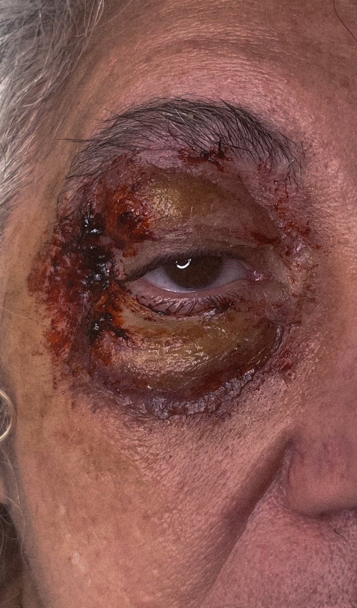 itsandraah's tweet image. ⚠️SFX MAKEUP⚠️

I made and applied these bondo prosthetics to my mom!! Need to improve some stuff but quite satisfied with my second try. I’m currently sculpting new ones lol 

#Sfx #makeupsfx #sfxmakeup #makeup #sfxtechnician #makeupeffects #prosthetic