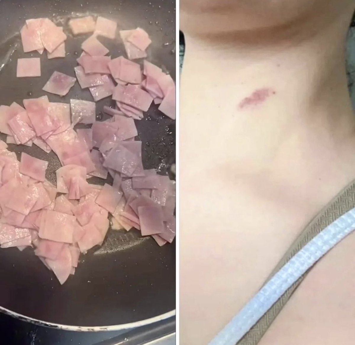 ZoeiraDaVidaofc's tweet image. Pessoal muito cuidado ao fritar coisas, minha namorada se queimou ontem a noite com isso!
