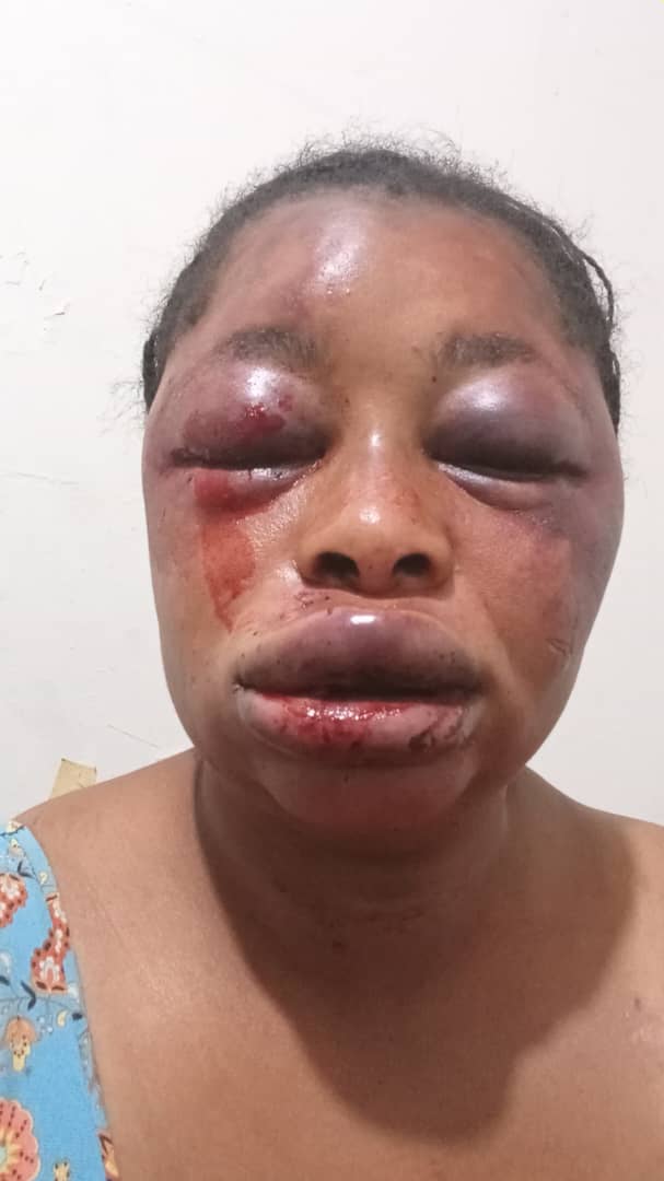 Fareeda_Ahmed_Q's tweet image. Hello good evening guys. Kindly assist us in finding the man in the photo. He is currently on the run after battering his wife to this condition. He was last seen at Kumasi. Kindly report to the nearest police station when you see him. 
Thank you!