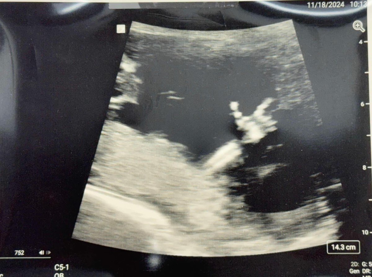 KCBD11's tweet photo. That’s one smart baby! ❤️🖤🖤
Dr. Scott Frankfather did an ultrasound last week in Denver City and this is what he saw! #FutureRedRaider? https://t.co/UearMILgmD