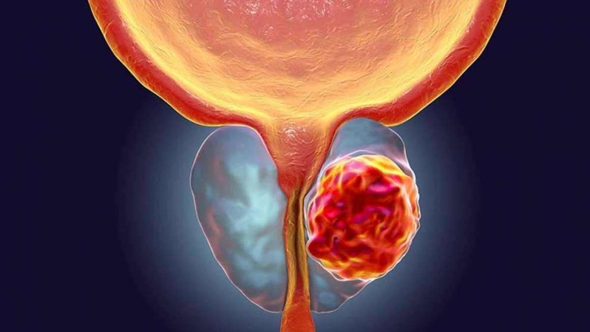 Exactas_UBA's tweet photo. 🧫Un equipo multidisciplinario de la Argentina identificó un pequeño grupo de genes que permite pronosticar con precisión cómo progresará un tumor de próstata. Ahora, trabajan en el desarrollo de un kit diagnóstico económico. El proyecto fue reconocido en dos concursos.

🥼“Todavía hoy, el cáncer de próstata se sigue diagnosticando con métodos que no son lo suficientemente precisos y esto deja a muchos hombres en la incertidumbre”, señala Geraldine Gueron, investigadora del @iquibicen.

🧬Utilizando técnicas de machine learning, el equipo logró identificar cuáles son los genes que, como reguladores maestros, controlan el destino celular. Esa “firma genética” está compuesta por un grupo de entre cinco y diez genes clave.

💉“Midiendo el nivel de expresión de nuestra firma de genes se puede generar un score y determinar con gran precisión cuál es el perfil genómico tumoral para cada paciente y, en consecuencia, se puede predecir la sobrevida”, asegura Gueron.

🏥Tras explicar que el kit pronóstico ya fue validado bioinformáticamente de manera exitosa con diferentes sets de datos independientes, Gueron anuncia: “Ya tenemos acuerdos con hospitales públicos y privados para validarlo a nivel clínico”.

Más detalles en la nota de @nex_ciencia: https://t.co/Fdi27kGLqb