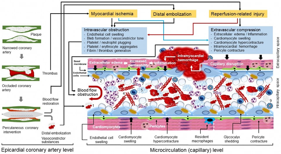 🔴Coronary No-Reflow after Primary PCI—Current Knowledge on Pathophysiology, Diagnosis, Clinical Impact and Therapy ⤵️ #2023Review #OpenAccess 

🔹mdpi.com/2077-0383/12/1…
 #Cardiology #FOAMed #MedEd #medstudent #paramedic #Cardiology #CardioEd #medtwitter #meded
