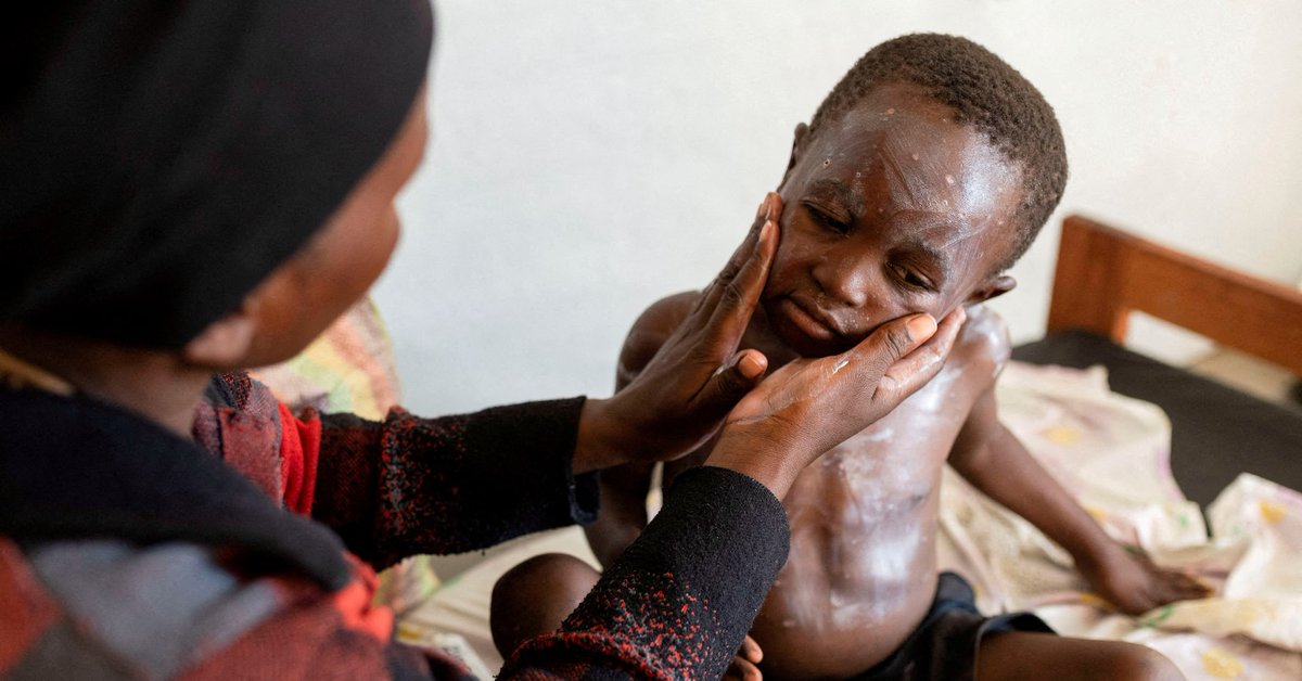 Reuters's tweet photo. New mpox vaccines for Congo's children held up by old problem https://t.co/wmSJzElxuy https://t.co/VMqxOQ3Thk