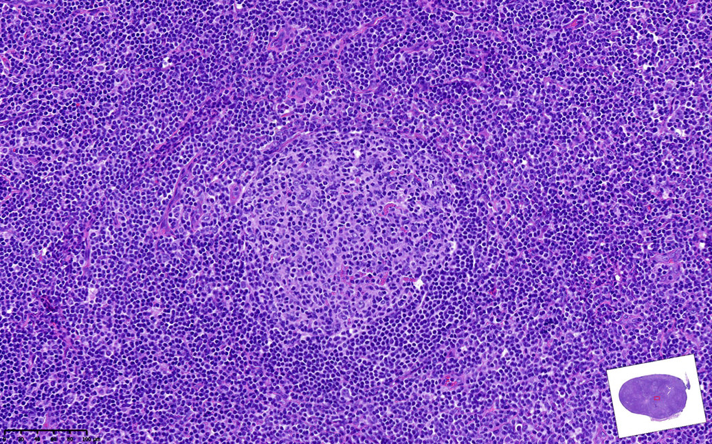 CuringN's tweet photo. Lymphoma &amp; related disorders - What's your diagnosis?

Topic link: Lymphoma &amp; related disorders

Images contributed by Elaine S. Jaffe, M.D.

Visit our CCN blog for cancer-related essays by Dr. Pernick: https://t.co/aaLBk9B2jb.

#CancerResearch #CuringCancerNetwork #Pathology https://t.co/NmJoY2FRlE