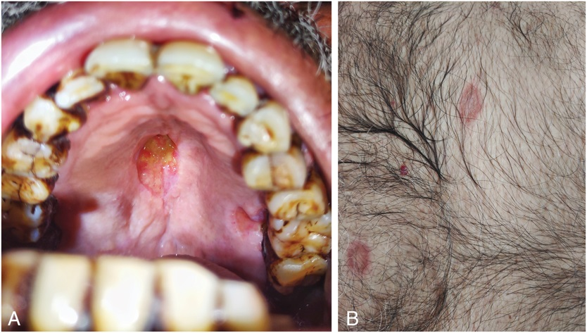 AJDP_Journal's tweet photo. #ClinicalPathologicChallenge
60yM presented with nonhealing painful ulcer over hard palate associated with odynophagia, and erythematous plaques and crusted erosions over trunk and thighs.
What is your diagnosis? https://t.co/yOI5bf4KgX