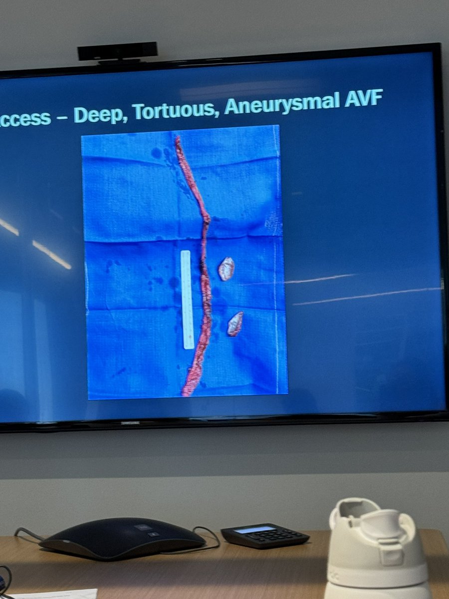 MCW Nephrology (@mcw_nephrology) on Twitter photo We’re lucky to be learning about vascular access from <a href="/MCWSurgery/">MCW Surgery</a> <a href="/nwkugler/">Nathan Kugler</a> today. key takeaways: Skin exam is critical, avoid the AC fossa, and refer early! We’re lucky to be learning about vascular access from <a href="/MCWSurgery/">MCW Surgery</a> <a href="/nwkugler/">Nathan Kugler</a> today. key takeaways: Skin exam is critical, avoid the AC fossa, and refer early!