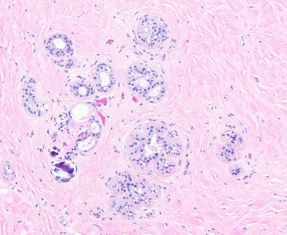 CakePath's tweet photo. Puffy apocrine metaplasia with associated microcalcifications...
#pathology #pathologists #PathTwitter #PathX #pathresidents #pathfellow #MedTwitter https://t.co/OoHqnBcslm