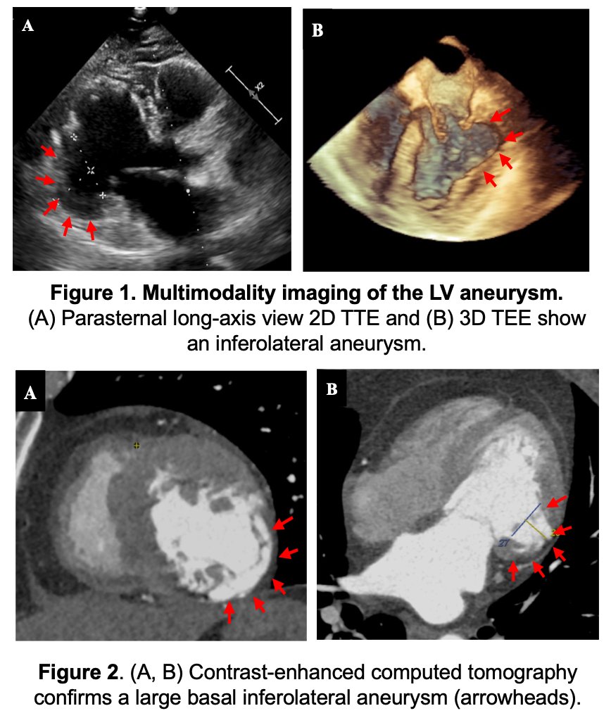 Juan Manuel Muñoz-Moreno, MD, FACC (@juanma_munoz29) on Twitter photo I am excited to share our two abstracts presented at the <a href="/American_Heart/">American Heart Association</a> Scientific Sessions #AHA24 and honored to collaborate with these amazing teams🌟🇵🇪#Match2025 #InternalMedicine <a href="/AAPPHealth/">American Association of Peruvian Physicians (AAPP)</a> <a href="/Becerra_MD/">Victor Becerra</a> <a href="/alterfan/">Carlos Requena</a> <a href="/mendozatrauco/">Cesar Mendoza, MD, FACC</a> ahajournals.org/doi/10.1161/ci… ahajournals.org/doi/10.1161/ci… I am excited to share our two abstracts presented at the <a href="/American_Heart/">American Heart Association</a> Scientific Sessions #AHA24 and honored to collaborate with these amazing teams🌟🇵🇪#Match2025 #InternalMedicine <a href="/AAPPHealth/">American Association of Peruvian Physicians (AAPP)</a> <a href="/Becerra_MD/">Victor Becerra</a> <a href="/alterfan/">Carlos Requena</a> <a href="/mendozatrauco/">Cesar Mendoza, MD, FACC</a> ahajournals.org/doi/10.1161/ci… ahajournals.org/doi/10.1161/ci…