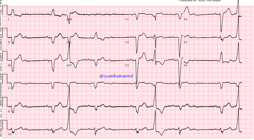 syamkumarmd's tweet photo. Interesting conduction pattern. What is the best explanation? #EPeeps #Fellowsfirst https://t.co/ewGraQsB01
