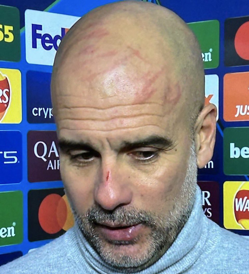 _BeFootball's tweet photo. 🚨 Pep Guardiola sur ses griffures au visage et sur son gros crâne chauve : 

« Je me suis fait ça avec mes doigts, car j’ai envie de me faire du mal. » 

(CP) https://t.co/B5SjSw6KyD