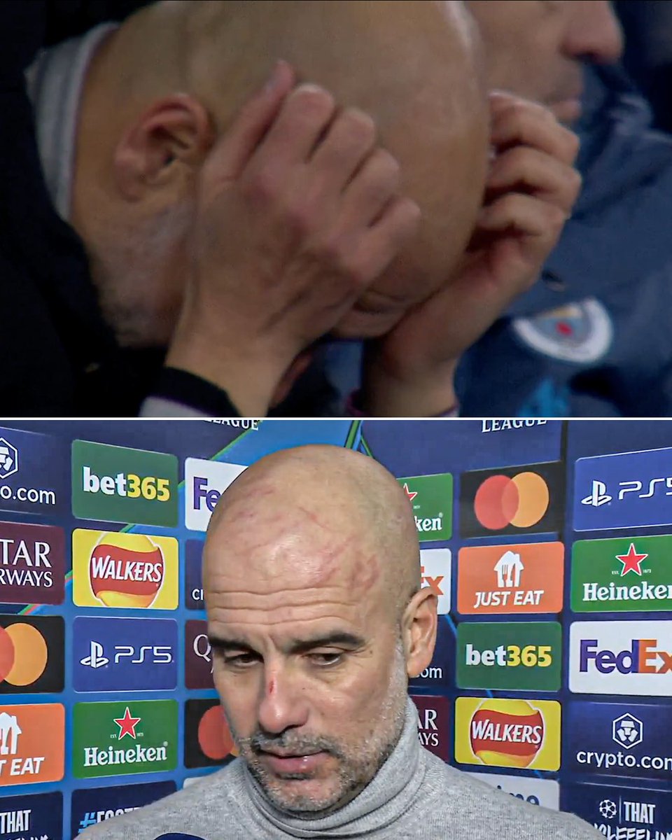 Pep had bruises and cuts on his head and nose after Man City blew a three-goal lead vs. Feyenoord 😮