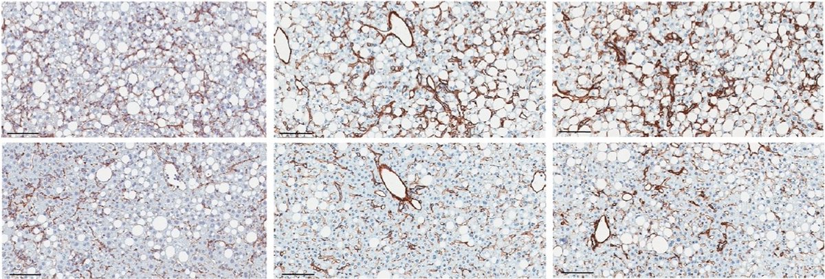 Hepatic Cell News (@hepaticcellnews) on Twitter photo Remember to look at the basement membrane. 👀
Drs. <a href="/prakramacha/">Prakash Ramachandran</a>, <a href="/JAFallowfield/">Jonathan Fallowfield</a>, <a href="/TimKendall_Path/">Tim Kendall</a>, and colleagues highlight the importance of basement membrane remodeling in MASH pathobiology and as a source of circulating biomarkers.
bit.ly/4g5xvv9 | <a href="/HepCommJournal/">Hepatology Communications</a> Remember to look at the basement membrane. 👀
Drs. <a href="/prakramacha/">Prakash Ramachandran</a>, <a href="/JAFallowfield/">Jonathan Fallowfield</a>, <a href="/TimKendall_Path/">Tim Kendall</a>, and colleagues highlight the importance of basement membrane remodeling in MASH pathobiology and as a source of circulating biomarkers.
bit.ly/4g5xvv9 | <a href="/HepCommJournal/">Hepatology Communications</a>