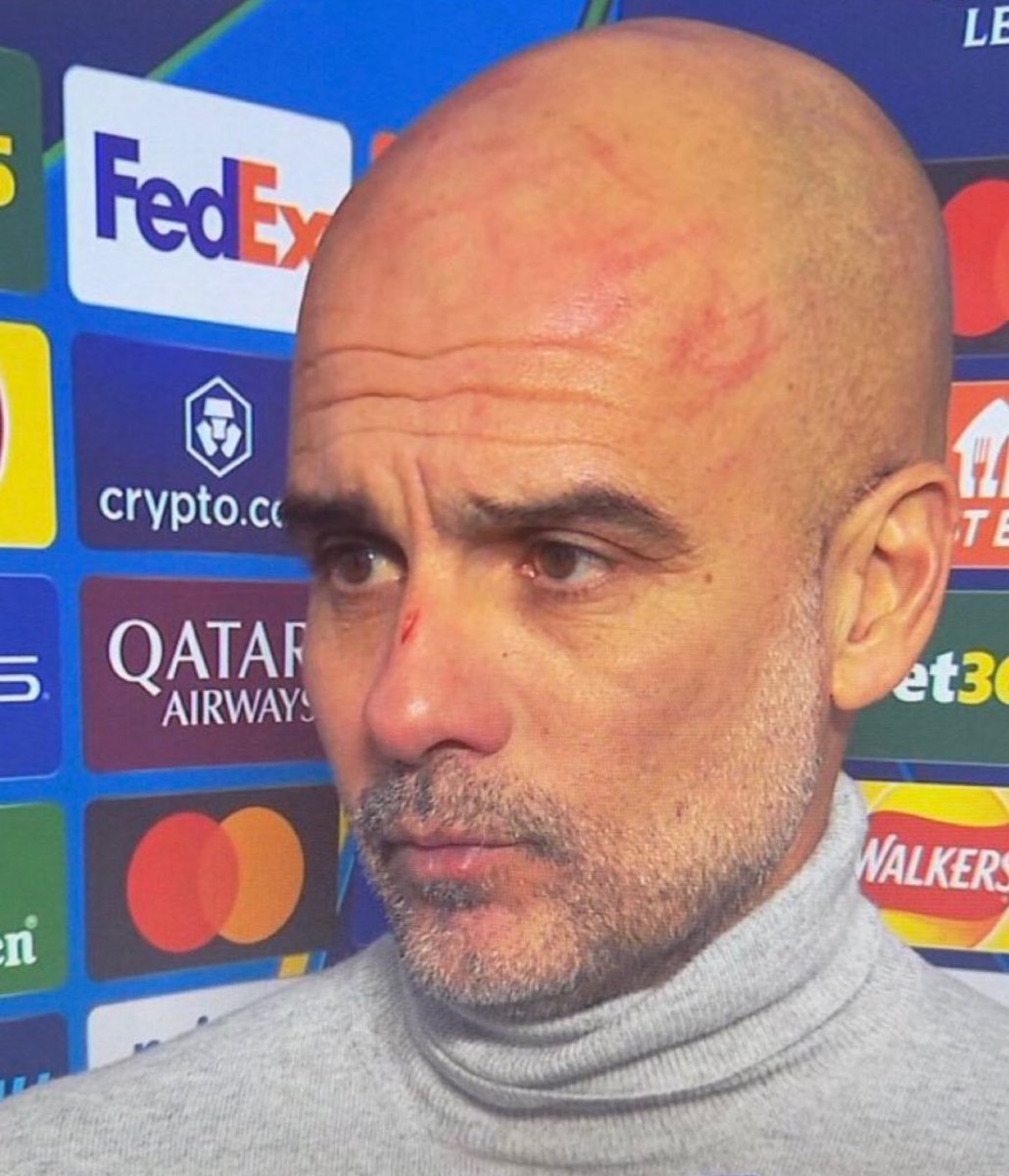 FUTEMENTALES's tweet photo. alguem avisa pro guardiola que stress faz o cabelo cair https://t.co/KL6rXURpfA