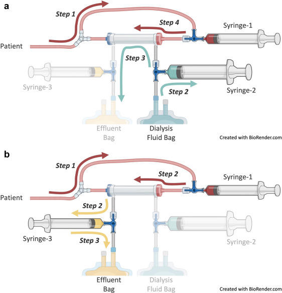 The Brophy Kit: a Manual #Hemodialysis Device for #Neonates

ow.ly/5oCA50UfxlU