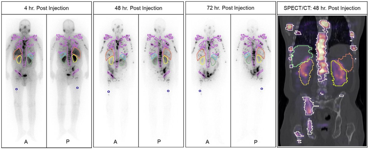 Personalized dosimetry assessment of [177Lu]Lu-PSMA-617 radioligand therapy in the management of metastatic castration-resistant prostate cancer bit.ly/3ClNJBU 

#radiopharmaceutical #pharmacy# #radiation #research #ijrb