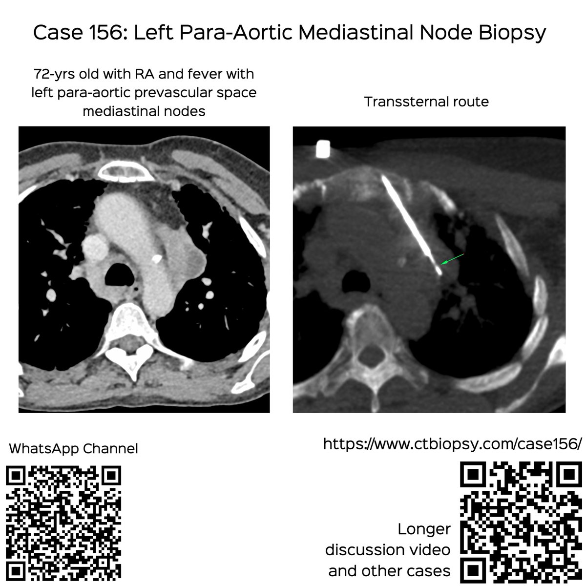 bhavinj's tweet photo. Case 156: Left Para-Aortic Mediastinal Node Biopsy
Transsternal Route
72-yrs old with RA ILD and nodal mass
Video discusses the case and approach to prevascular mediastinal biopsies
https://t.co/ShAqJHec2c
#ctbiopsy #irrad #mediastinalbiopsy #prevascular #transsternal https://t.co/mlqcVAndmL