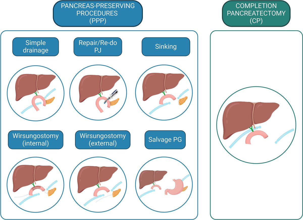Gio_Marchegiani's tweet photo. Reoperation for pancreatic fistula 🐳

🤜🤛 Completion pancreatectomy or pancreas-preserving procedures ?!

💦 Drainage / wirsungostomy most used 44% vs. Completion panc 37%

😱 Mortality as high as 67%! 

👀 What is your policy? Thoughts? 

🆓 paper 👉 https://t.co/Dn8eIA9qEG https://t.co/t5mMolONEs