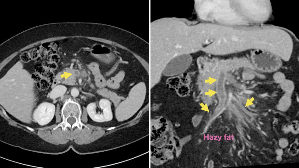 Often in radiology, it's hard to see what's NOT there (but  yellow arrows help, of course)... 

So what's missing? 

#radiology #radres #MedEd