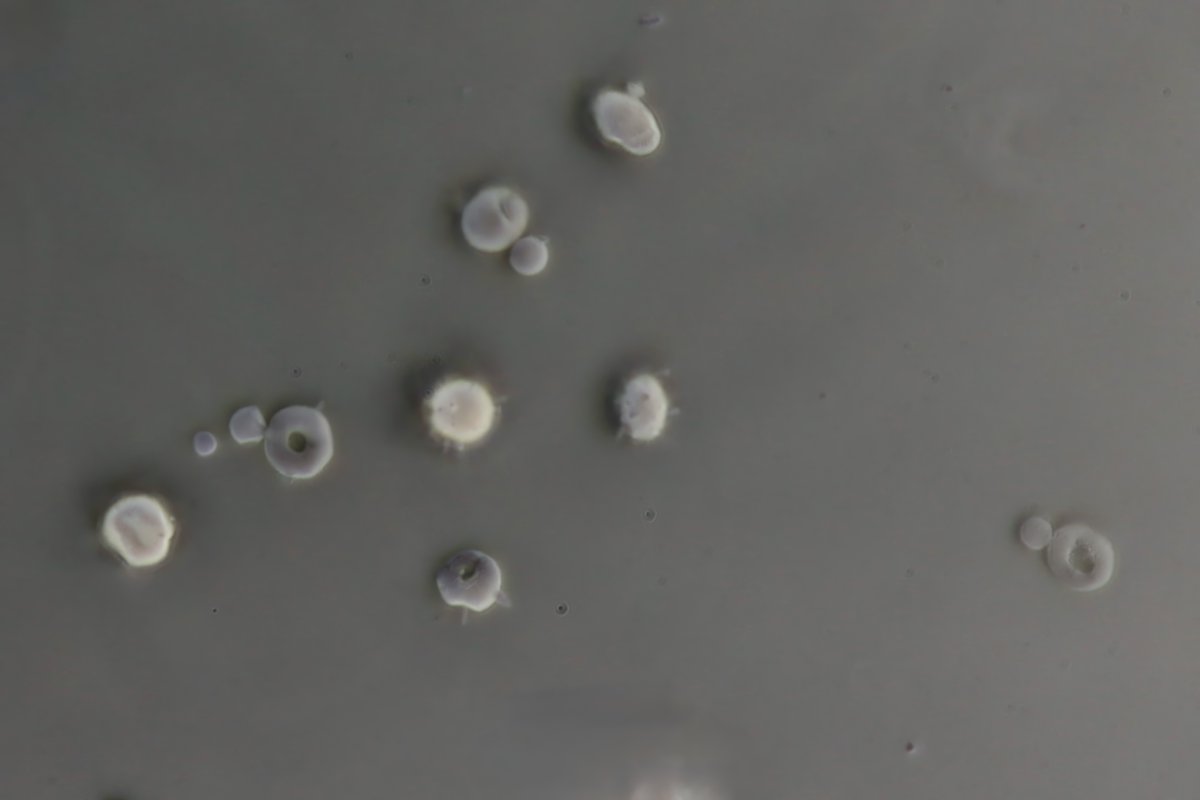 jrseltzer's tweet photo. Some acanthocytes - under oblique and darkfield illumination - from patient with AKI and new pulmonary infiltrates -
#UrineMicroscopy
#UrinarySediment https://t.co/nfOIt3sP8R