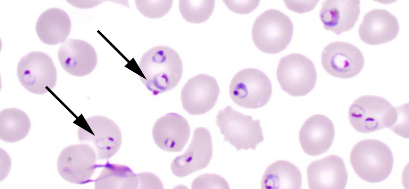 brainrotgaIore's tweet photo. Plasmodium falciparum

LEFT: Binucleate rings (double chromatin) resembling  "HEADPHONES" in appearance

RIGHT: Mature gametocytes in peripheral smears are curved oblong structures, described as "CRESCENT" "SICKLE" "SAUSAGE" or "BANANA" - shaped https://t.co/wmTtTnD3xV