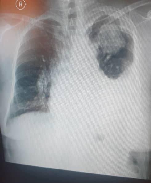34y/F presents with SOB.
What's the diagnosis?