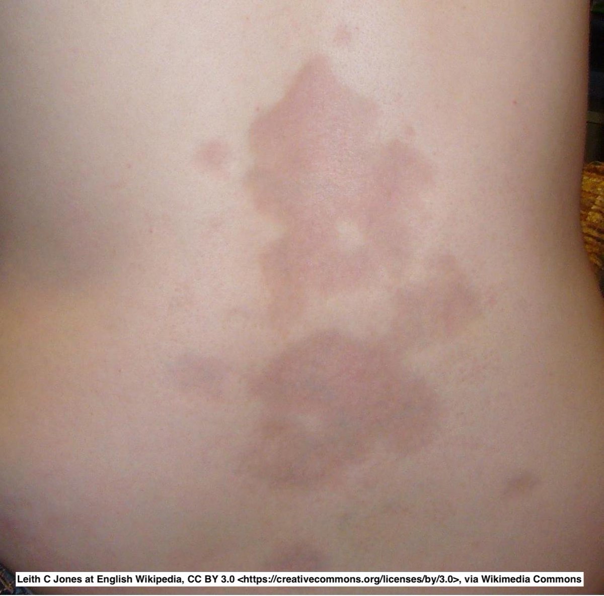 Path4People's tweet image. I am a localized form of a systemic process

I look like a &quot;square&quot; in punch biopsies

I have a spectrum of change but classically show thick collagen, entrapped/atrophic adnexa+/- perivascular and periadnexal inflammation (esp if earlier)

Who am I? 

🤔#dermpath #fammed #pathx