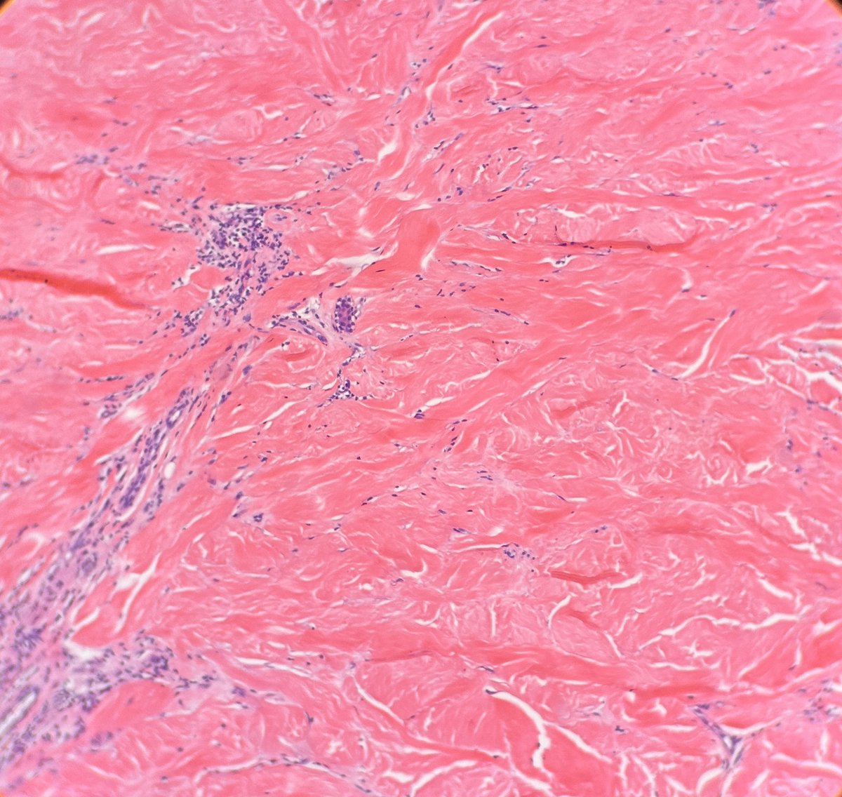 Path4People's tweet image. I am a localized form of a systemic process

I look like a &quot;square&quot; in punch biopsies

I have a spectrum of change but classically show thick collagen, entrapped/atrophic adnexa+/- perivascular and periadnexal inflammation (esp if earlier)

Who am I? 

🤔#dermpath #fammed #pathx