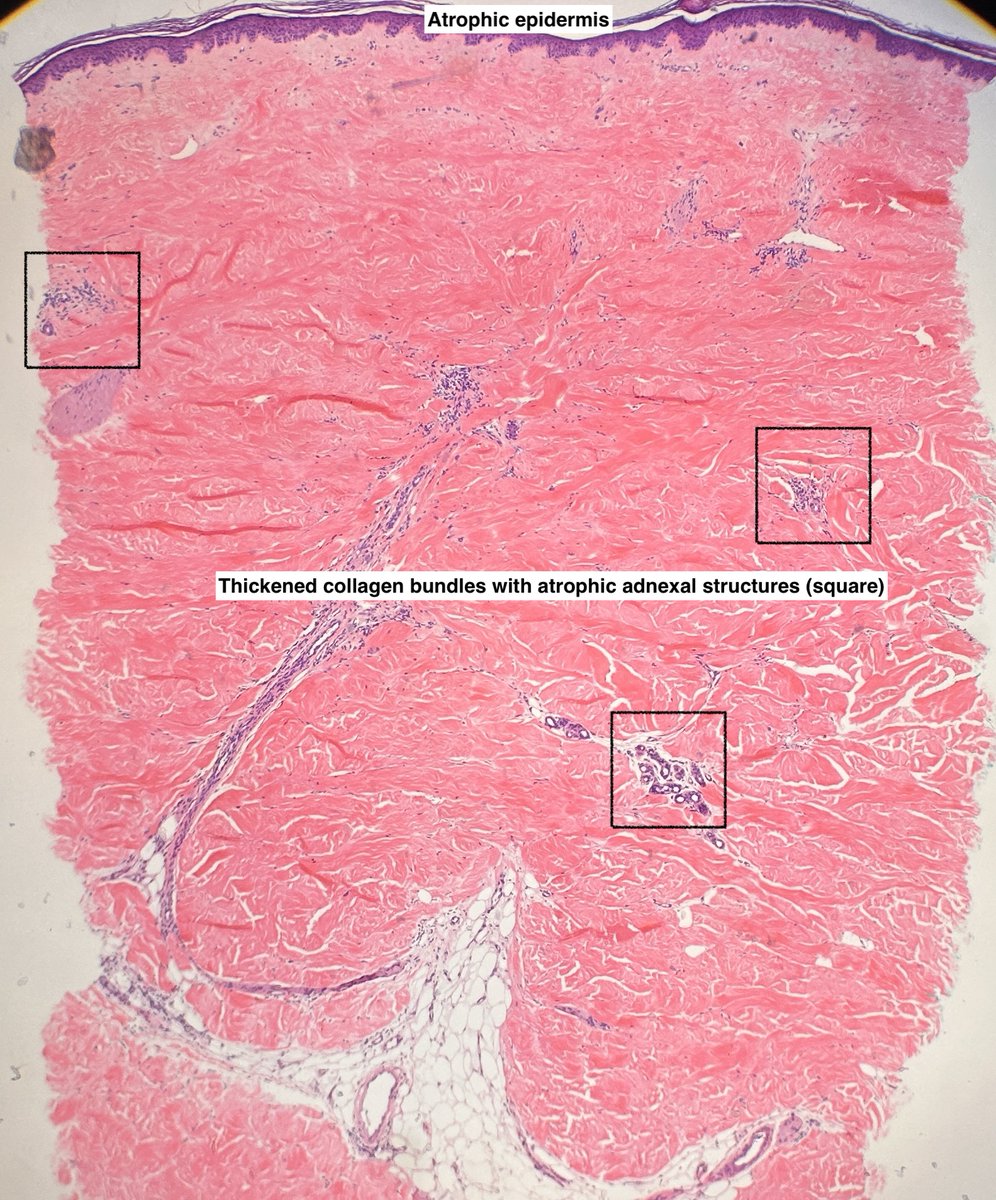 Path4People's tweet image. I am a localized form of a systemic process

I look like a &quot;square&quot; in punch biopsies

I have a spectrum of change but classically show thick collagen, entrapped/atrophic adnexa+/- perivascular and periadnexal inflammation (esp if earlier)

Who am I? 

🤔#dermpath #fammed #pathx