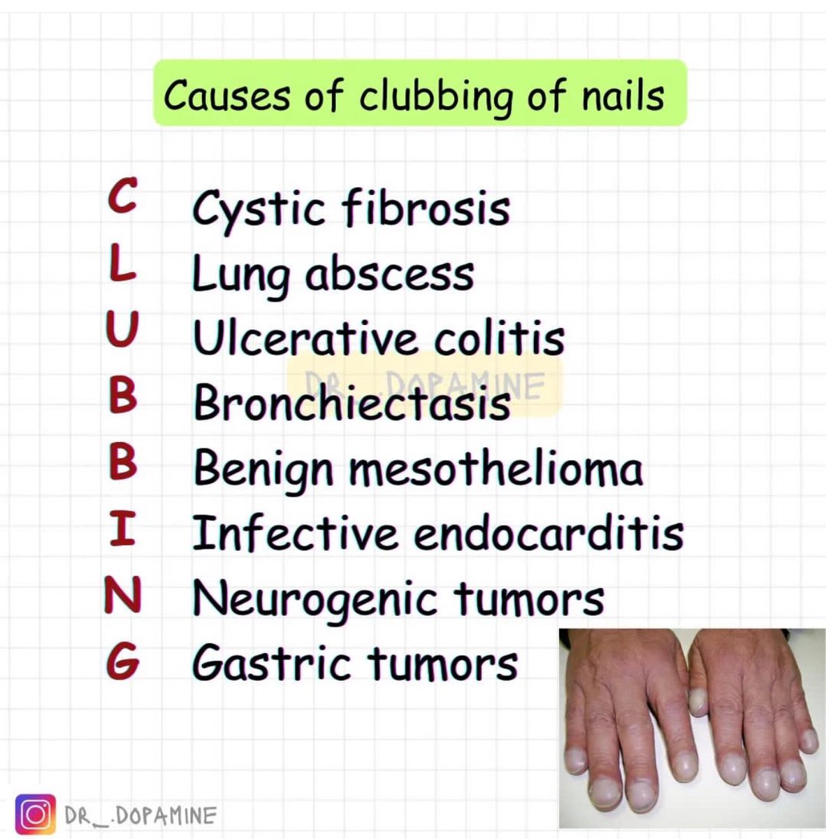 DrMedica_13's tweet photo. Causes of Clubbing 💅 
•••
#CLUBBING #MedEd #MedX https://t.co/t8GKlCRL27