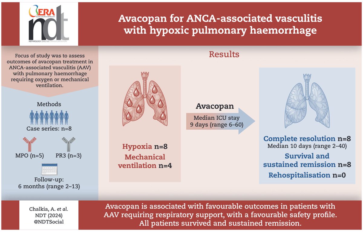 Avacopan for ANCA-associated vasculitis with hypoxic pulmonary haemorrhage academic.oup.com/ndt/article/39…