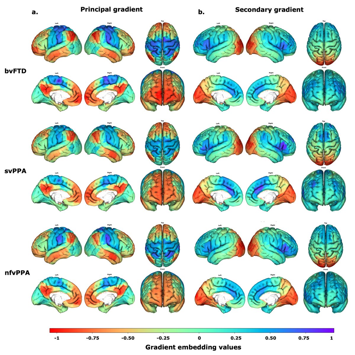 Super excited the 1st paper of my PhD is now published in <a href="/SpringerNature/">Springer Nature</a> <a href="/molpsychiatry/">molecularpsychiatry</a>: 

"Disruption of macroscale functional network organisation in patients with frontotemporal dementia"
#FTD #neuroimaging

Read here: rdcu.be/d1gAu

<a href="/InstitutCerveau/">Institut du Cerveau - Paris Brain Institute</a>  <a href="/drcionucl/">DRC@UCL</a>
