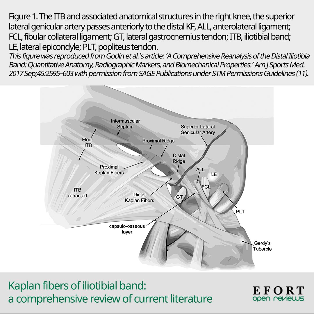 EFORTnet's tweet image. EFORT #OpenReviews covers various lateral extra-articular tenodesis techniques used to address residual laxity and instability following #ACLreconstruction 📄 bit.ly/3zZmGLO #Kaplanfibers #knee #tenodesis #anteriorcruciateligament #biomechanics #orthopedics #orthopaedics