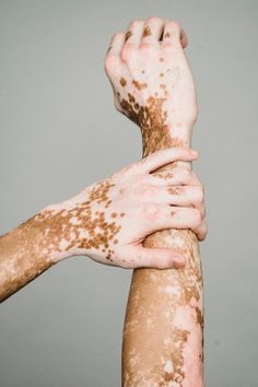 pataconesPA's tweet photo. An educational thread abt vitiligo  🧵 https://t.co/GUI8C6g9fp