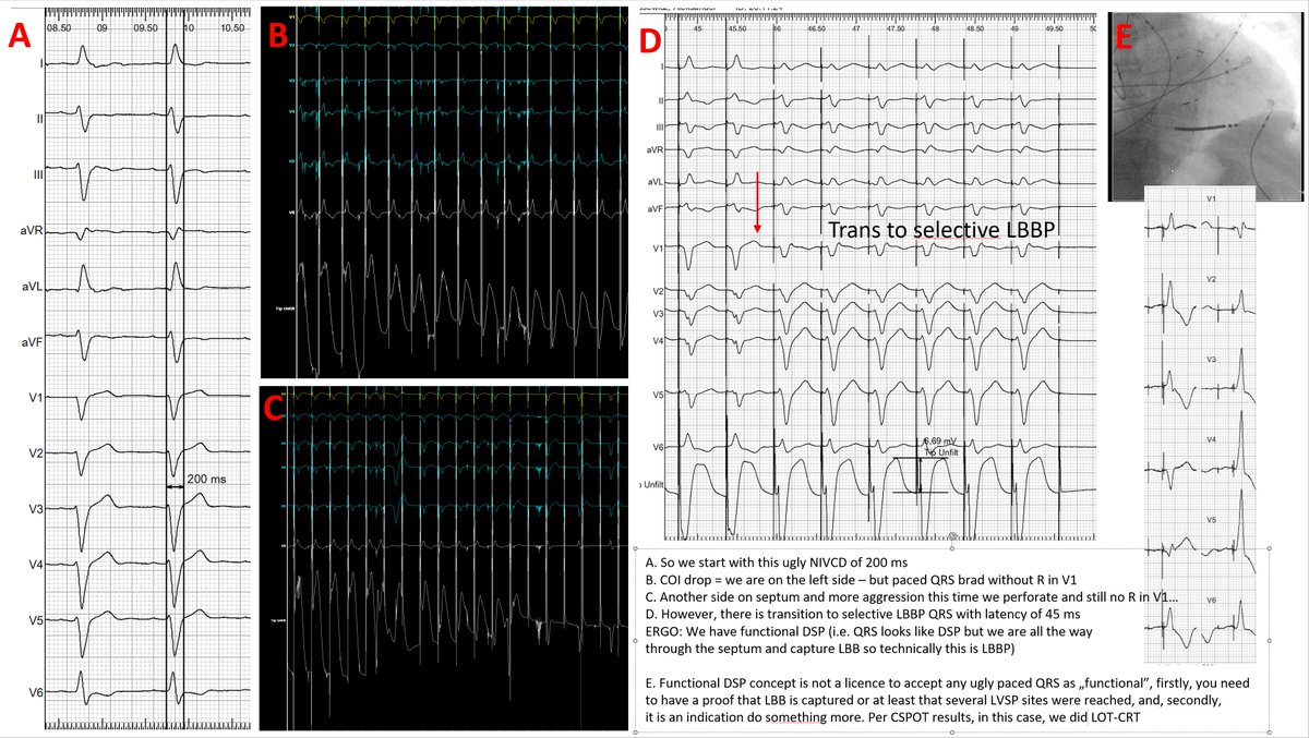 Marek Jastrzębski (@marek_jastrz_ep) on Twitter photo Yesterday's FUNCTIONAL DSP case. F-DSP concept is not a licence to accept any ugly paced QRS. 1) proof of LBB capture or LVSP position is required, 2) should do something more!
#Epeeps
<a href="/ZacharyWhinnett/">Zachary Whinnett</a>
<a href="/OCanoPerez/">Óscar Cano</a>
<a href="/MargaridaPujol/">Margarida Pujol Lopez</a>
<a href="/kvernooy/">Kevin Vernooy</a>
<a href="/micogriecomd/">micogriecomd</a>
<a href="/Dr_JozaEP/">Jacqueline Joza</a>
<a href="/Hisdoc1/">Pugal Vijayaraman</a> Yesterday's FUNCTIONAL DSP case. F-DSP concept is not a licence to accept any ugly paced QRS. 1) proof of LBB capture or LVSP position is required, 2) should do something more!
#Epeeps
<a href="/ZacharyWhinnett/">Zachary Whinnett</a>
<a href="/OCanoPerez/">Óscar Cano</a>
<a href="/MargaridaPujol/">Margarida Pujol Lopez</a>
<a href="/kvernooy/">Kevin Vernooy</a>
<a href="/micogriecomd/">micogriecomd</a>
<a href="/Dr_JozaEP/">Jacqueline Joza</a>
<a href="/Hisdoc1/">Pugal Vijayaraman</a>