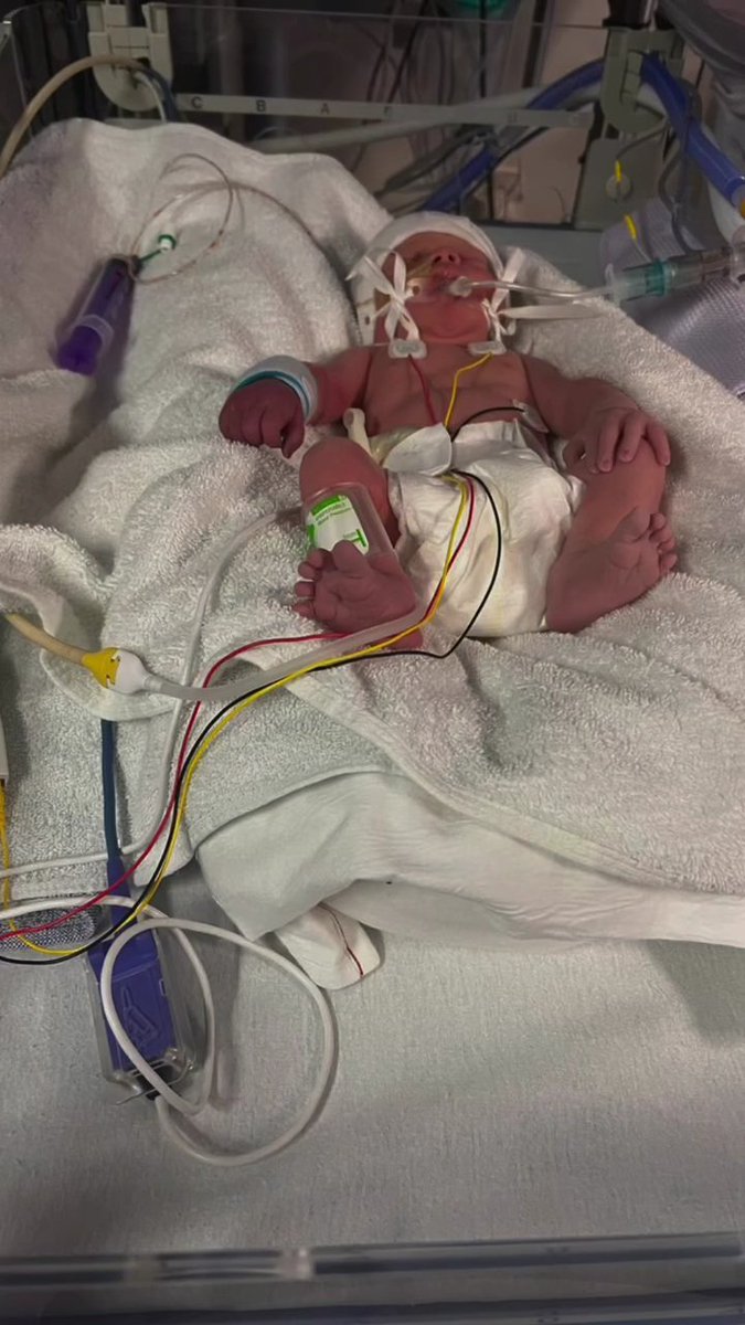 fazethego's tweet photo. @based16z Please Help me someone stole over my 80,000$ in  token last Month . 

My son was diagnosed with acute respiratory distress syndrome (lungs not fully developed) he is in ventilator care from last week. I need injections to save him whose cost is 3800$(curosurf). https://t.co/ZhfkI3NVdk