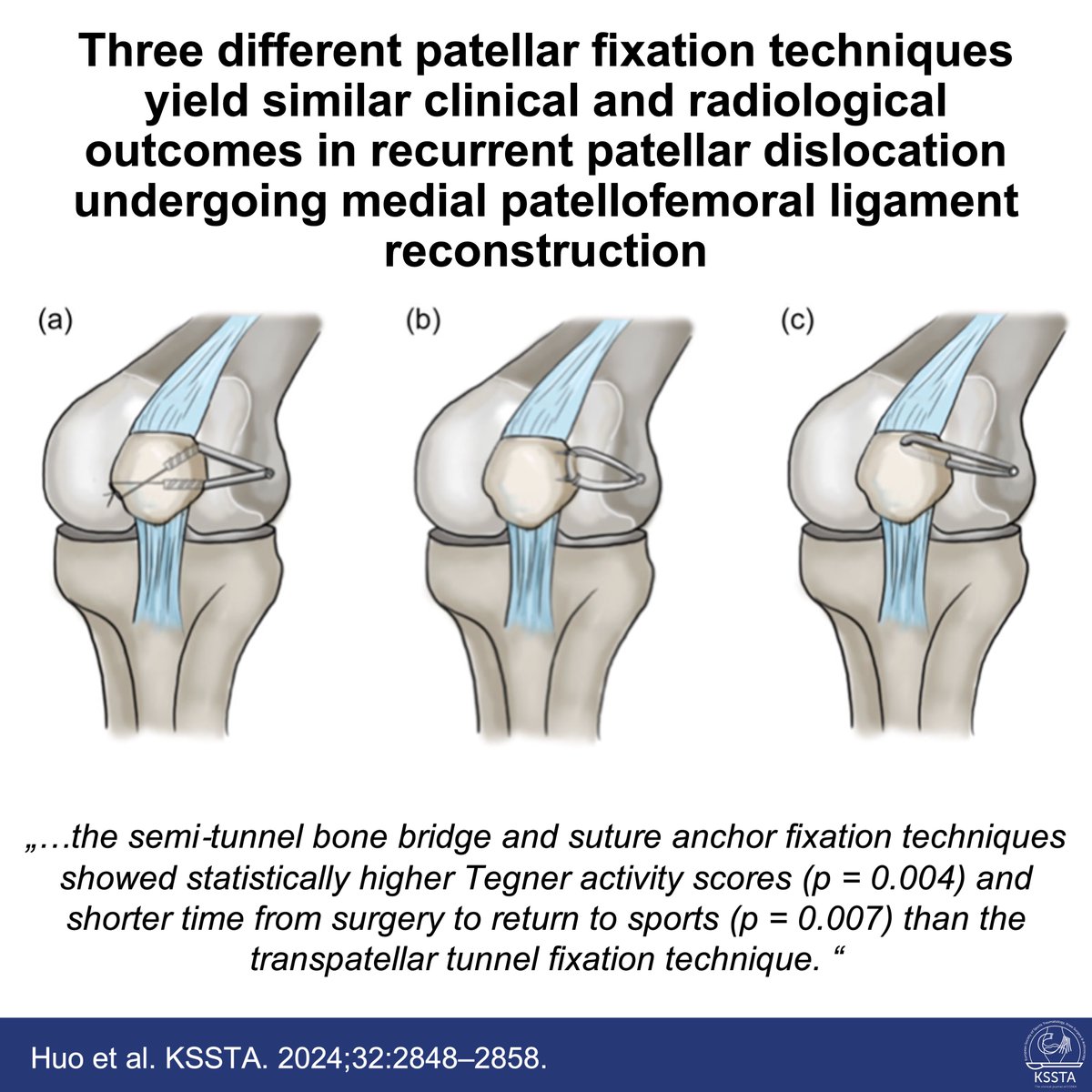What is the optimal patellar fixation technique for MPFL reconstruction. This question is addressed by this new clinical study.
 
#knee #patellofemoral #MPFL #reconstruction #KSSTA
 
Read here: doi.org/10.1002/ksa.12…