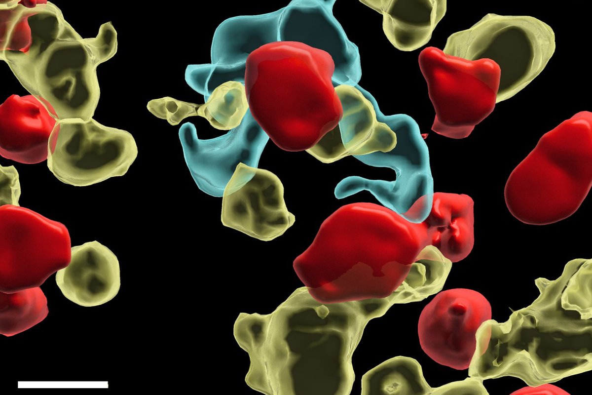 IMP (@impvienna) on Twitter photo #Immunotherapy has transformed #cancer treatment, but some cancers evade immune defenses, causing resistance.
<a href="/obenaufa/">Anna Obenauf</a>'s lab has discovered how inflammatory monocytes—a type of immune cell—can reactivate cancer-killing T cells within tumors.
Read more: imp.ac.at/news/article/a… #Immunotherapy has transformed #cancer treatment, but some cancers evade immune defenses, causing resistance.
<a href="/obenaufa/">Anna Obenauf</a>'s lab has discovered how inflammatory monocytes—a type of immune cell—can reactivate cancer-killing T cells within tumors.
Read more: imp.ac.at/news/article/a…