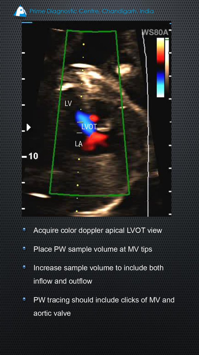 drupsinghin's tweet image. How to take PR Interval on Fetal Echocardiography.

Watch Now: lnkd.in/gwyMr_bx

#FetalEcho #PRInterval #AVblock #AntoRo #AntiLA