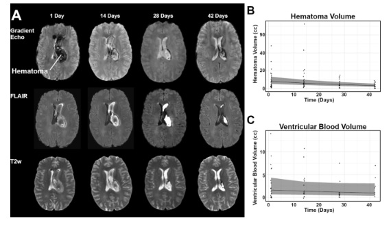 Neurocritical Care (@neurocritcarej) on Twitter photo Vyas et al: Serial Diffusion Tensor Imaging and Rate of Ventricular Blood Clearance in Patients with Intraventricular Hemorrhage
Link: ow.ly/JTNO50TtUPv
<a href="/neurocritical/">Neurocritical Care Society</a> #neurocritcare Vyas et al: Serial Diffusion Tensor Imaging and Rate of Ventricular Blood Clearance in Patients with Intraventricular Hemorrhage
Link: ow.ly/JTNO50TtUPv
<a href="/neurocritical/">Neurocritical Care Society</a> #neurocritcare