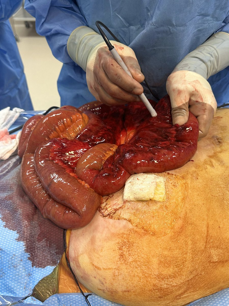 Avery Walker, MD, FACS, FASCRS tweet media