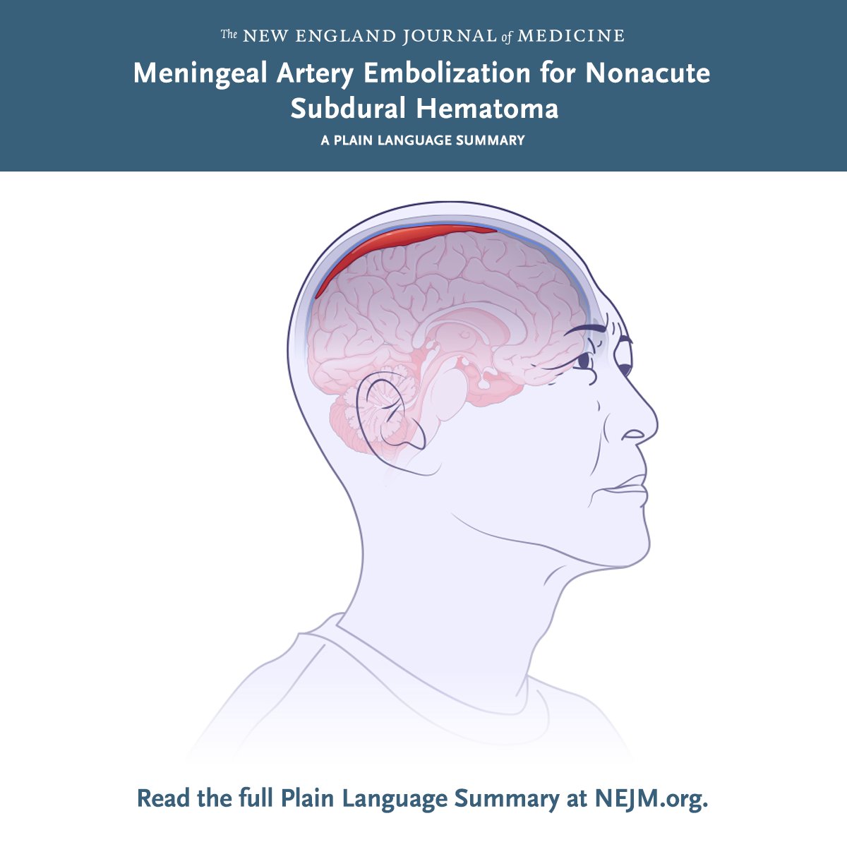 Among patients with nonacute subdural hematoma, middle meningeal artery embolization led to a 90-day incidence of symptomatic recurrence or progression similar to that with usual care but with fewer serious adverse events. Full MAGIC-MT trial results: nej.md/3UZm6oM