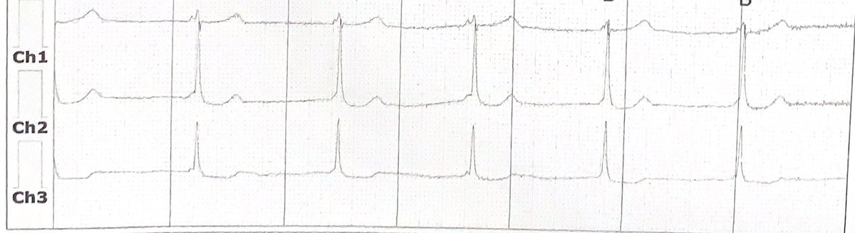 WPW 
or 
Accrochage?