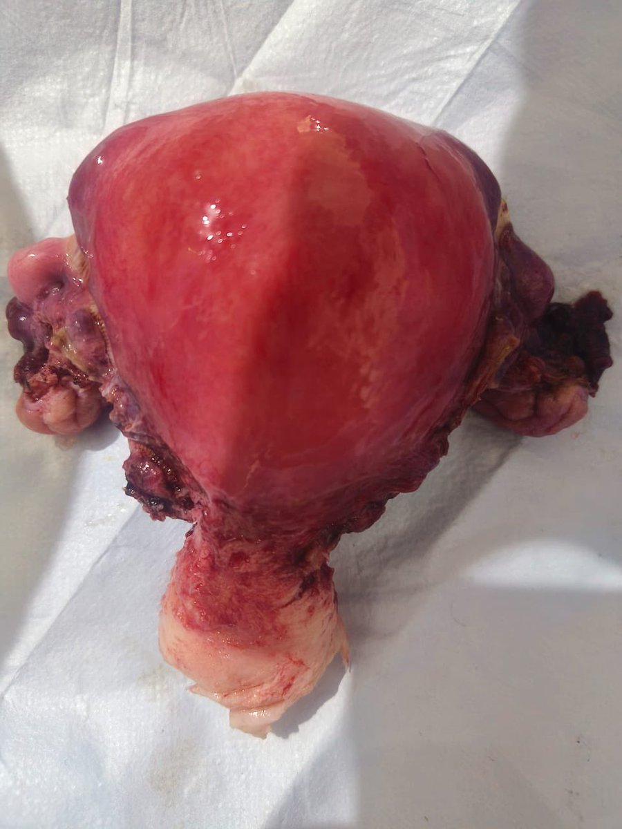 Butt_Aijaz's tweet photo. First ever Total abdominal hysterectomy done in ADH ,GMC HANDWARA.
Congratulations to dept of Gynae/Obs and team of Theater.
Milestone achieved in constrained space.
@SyedAbidShah Sir! https://t.co/8OhLatB8pO