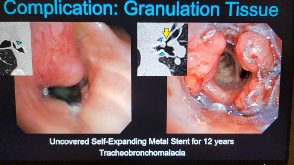 Maria Daniela Martin, M.D. (@danielamartinmd) on Twitter photo If you are still here, join us to learn about thoracic devices! I'll talk about stents and endobronchial valves at N227B at 430 PM! <a href="/DanielVargasMD/">Daniel Vargas, MD</a> <a href="/UWiscRadiology/">UW Radiology</a> #RSNA2024 If you are still here, join us to learn about thoracic devices! I'll talk about stents and endobronchial valves at N227B at 430 PM! <a href="/DanielVargasMD/">Daniel Vargas, MD</a> <a href="/UWiscRadiology/">UW Radiology</a> #RSNA2024