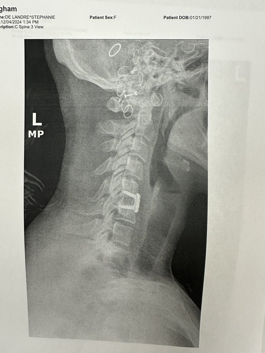 stephdelander's tweet image. Had my 6 week follow up appt with my surgeon today. THANK YOU to Dr. Andrew Cordover &amp;amp; the entire team for taking such great care of me. I will be back in the ring at 100% in no time thanks to you guys! 🙏🏼♥️💪🏼 #DrAndrewCordover #AndrewsSportsMedicine #SpinalFusion