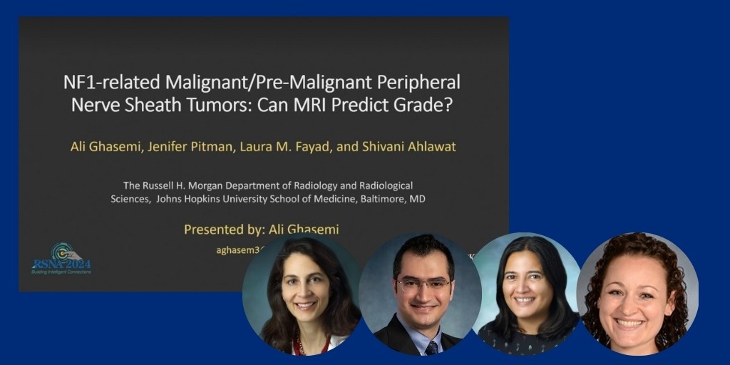 Johns Hopkins Radiology (@hopkins_rad) on Twitter photo Research Fellow Ali Ghasemi (<a href="/AliGhasemi110/">Ali Ghasemi</a>), with coauthors Professor <a href="/LauraMFayad/">Laura Fayad</a>, Assistant Professor Jenifer Pitman and Associate Professor Shivani Ahlawat (<a href="/ahlawat_shivani/">Shivani Ahlawat</a>), shared their research into MRI imaging of MPNST tumors during “Neurofibromatosis Type 1 Research Fellow Ali Ghasemi (<a href="/AliGhasemi110/">Ali Ghasemi</a>), with coauthors Professor <a href="/LauraMFayad/">Laura Fayad</a>, Assistant Professor Jenifer Pitman and Associate Professor Shivani Ahlawat (<a href="/ahlawat_shivani/">Shivani Ahlawat</a>), shared their research into MRI imaging of MPNST tumors during “Neurofibromatosis Type 1