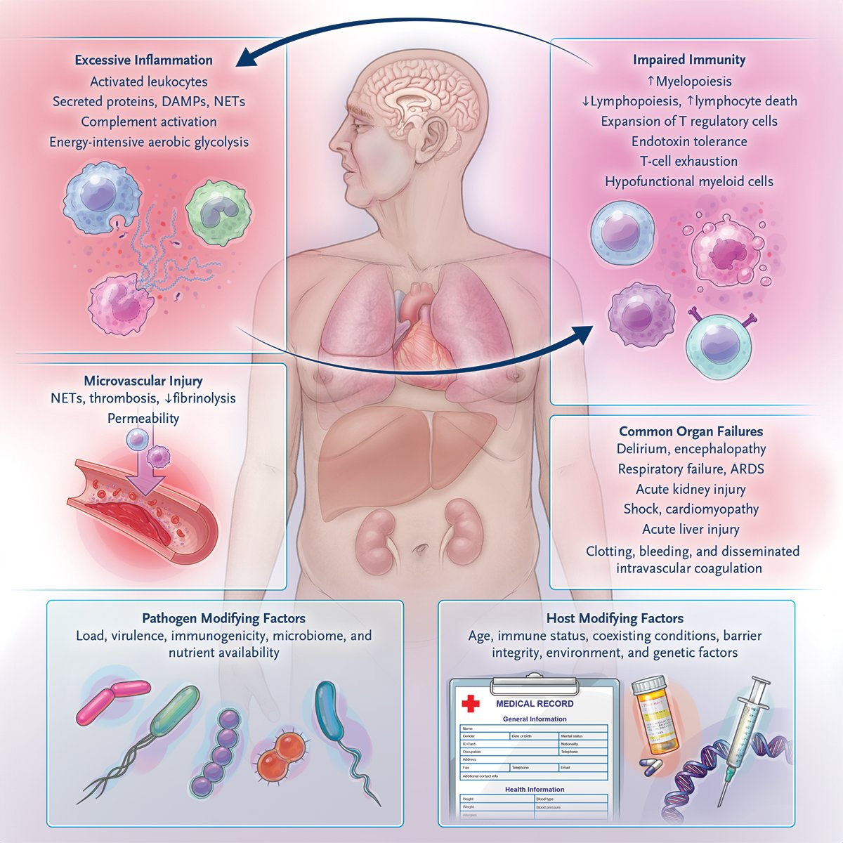 Sepsis is a life-threatening, heterogeneous disorder involving a dysregulated immune response to infection. Research to identify subtypes and targeted therapies for host dysregulation is ongoing. Read the full review: nej.md/3OFrGZR