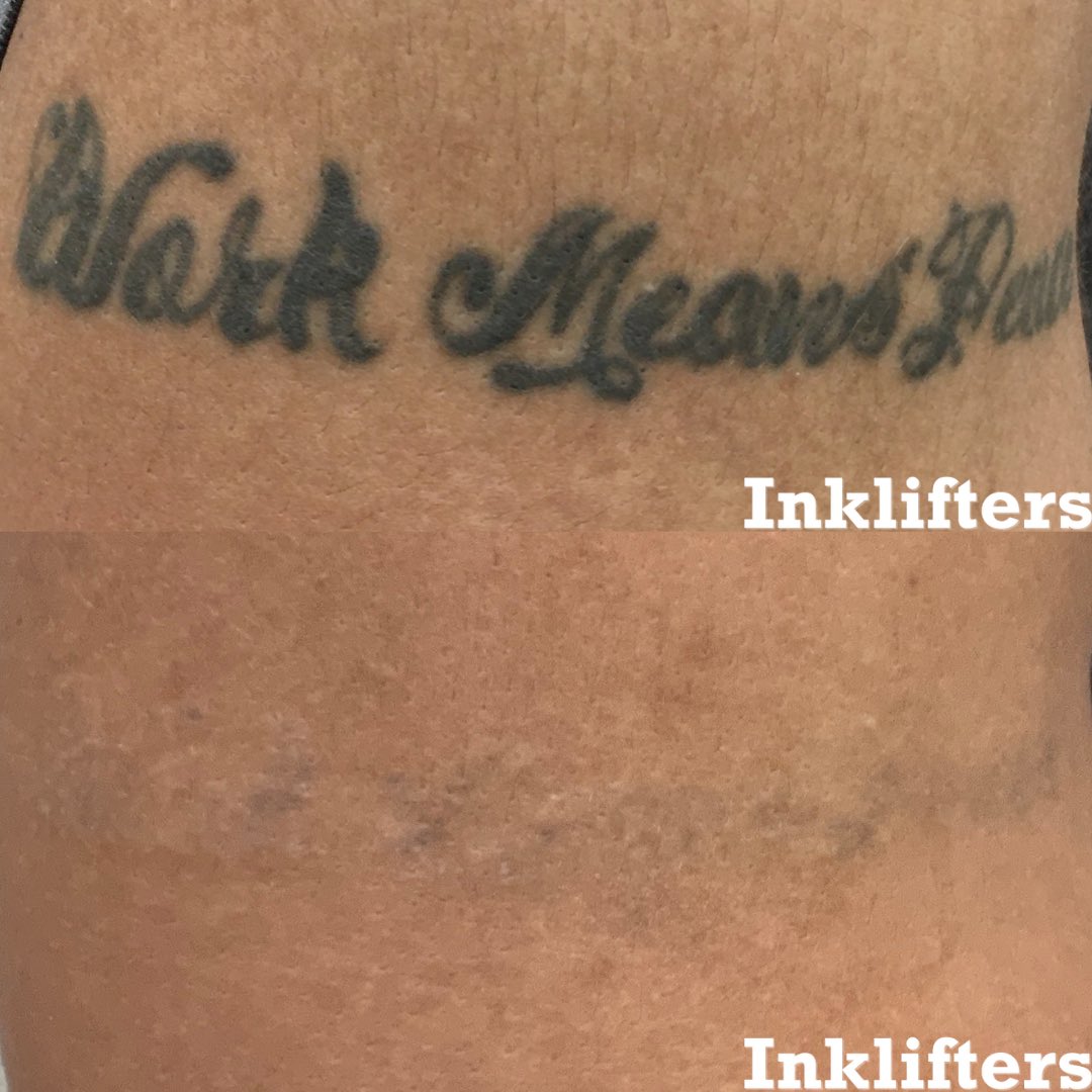 Ink, erased! 😎 Check out this incredible transformation after just 6 laser tattoo removal sessions. Whether it’s a faded memory or a design you’ve outgrown, our advanced laser technology helps you start fresh with minimal downtime.